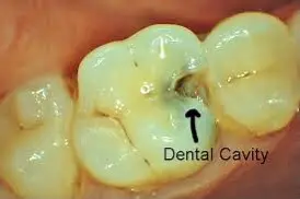 Imagem de uma cárie em um dente