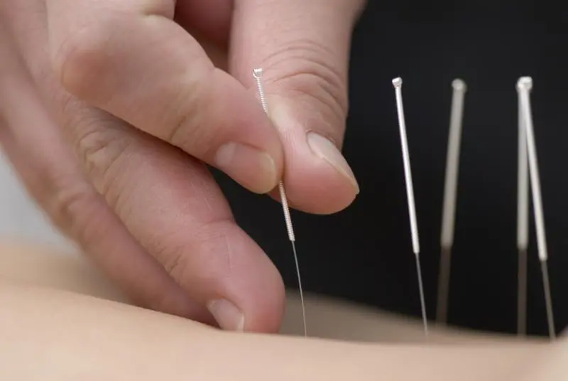 Acupuncture needles being placed in the skin