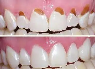 Dentes antes e depois do tratamento