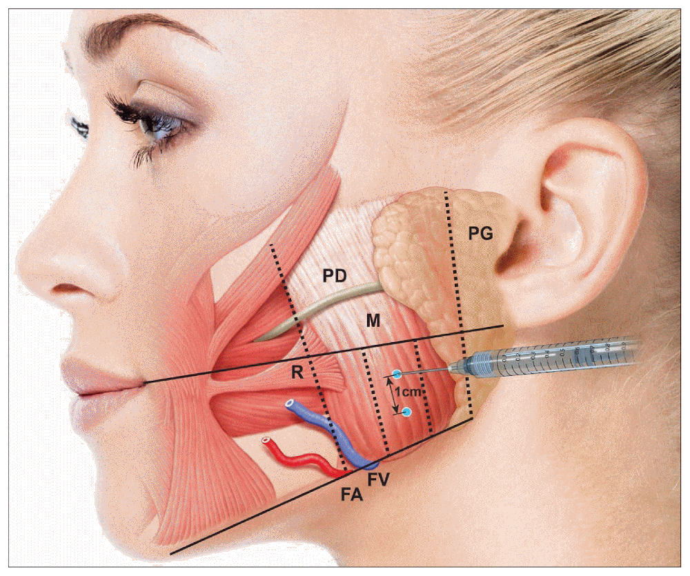 Illustration of botox being injected into the cheek
