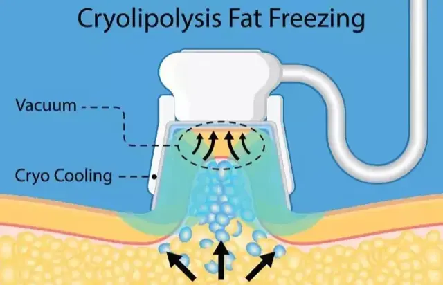 Cryolipolysis Fat Freezing graphic