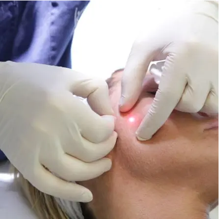 A female face receiving endolaser treatment