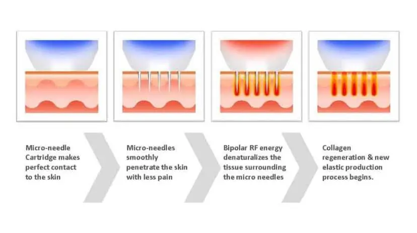 Gráfico descrevendo como a radiofrequência fracionária funciona