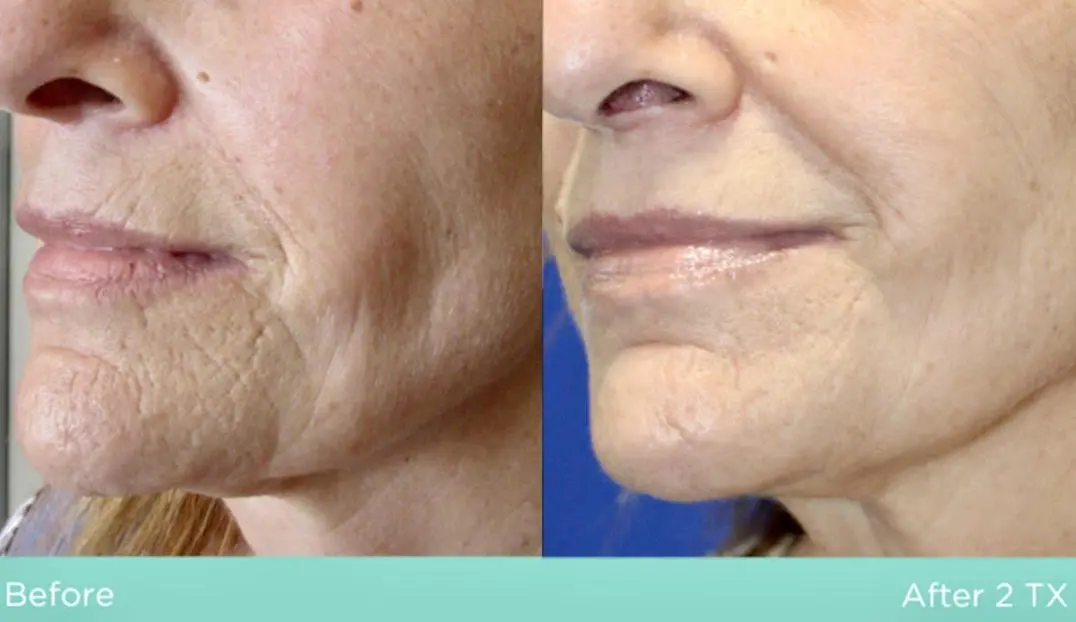 Before and after fractional radio frequency treatment