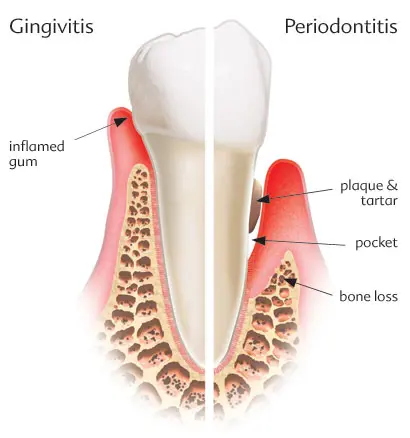 Graphic showing types of gum disease