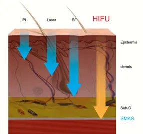 A graphic showing the depth that HIFU treatment reaches