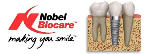 Implantes dentários Nobel Biocare