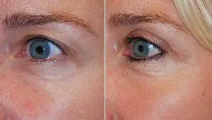 Before and after eyelid correction