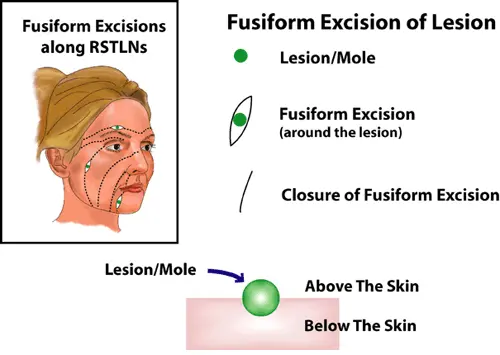 Graphic showing fusiform excision details