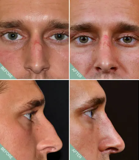 Before and after nose reshaping