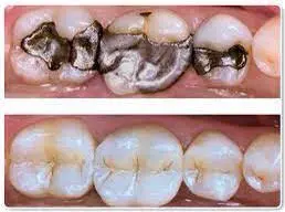 Teeth with and without amalgam