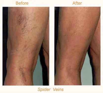 Leg Spider Veins & Thread Vein Removal