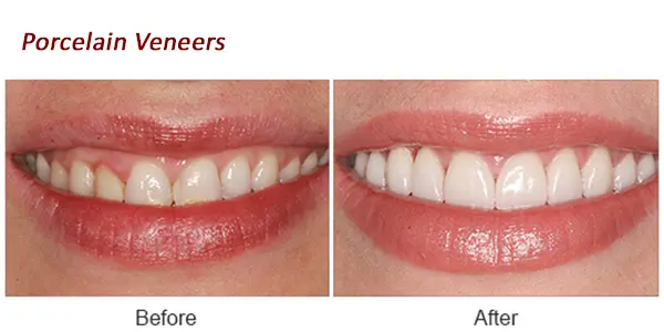 Example of porcelain veneers before and after
