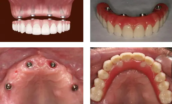 Examples of fixed dental implant bridges