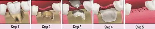 Graphic showing the jawbone grafting procedure